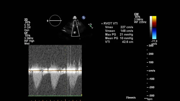 Kép Szív Alatt Transesophagealis Ultrahang Doppler Módban — Stock Fotó