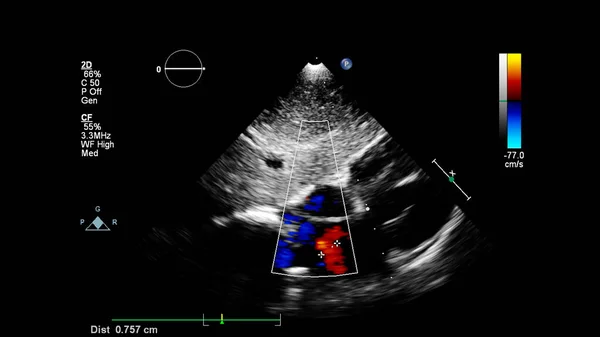 Imagen Del Corazón Durante Ecografía Transesofágica Con Modo Doppler —  Fotos de Stock