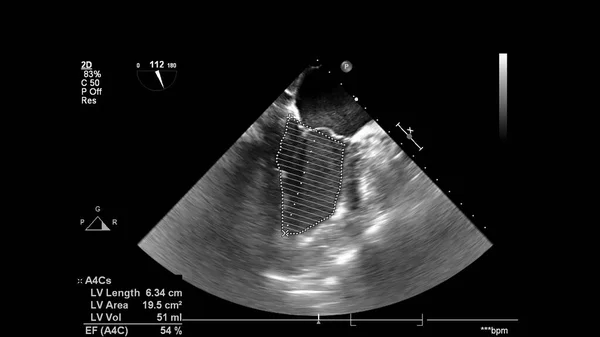 Transesofageal Ultrason Sırasında Kalbin Gri Ölçekli Görüntüsü — Stok fotoğraf