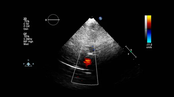 Imagen Del Corazón Durante Ecografía Transesofágica Con Modo Doppler —  Fotos de Stock