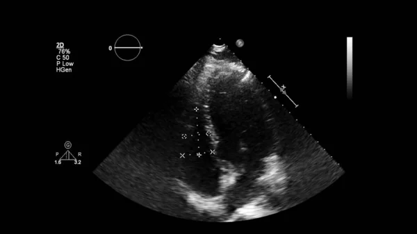 経食道超音波検査時のグレースケールモードで心臓の画像 — ストック写真