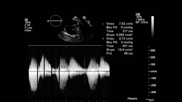 Transesofageal Ultrason Sırasında Kalbin Gri Ölçekli Görüntüsü — Stok fotoğraf