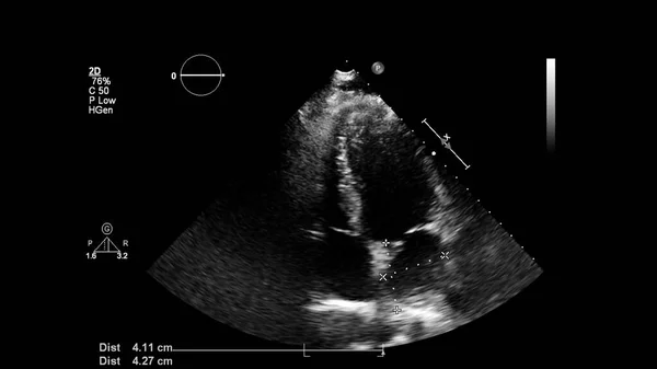 Transesofageal Ultrason Sırasında Kalbin Gri Ölçekli Görüntüsü — Stok fotoğraf