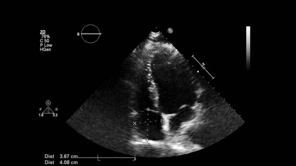 Изображение сердца в сером режиме во время трансофагеального ультразвука.