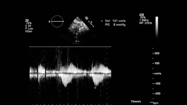 Kép Szív Szürke Skála Mód Során Transesophagealis Ultrahang — Stock Fotó