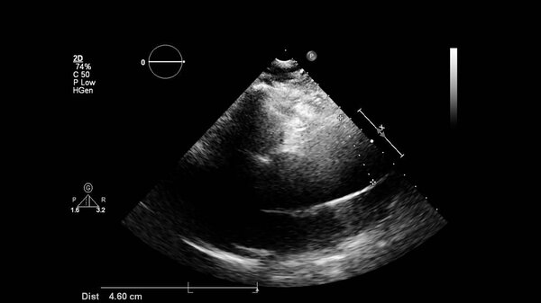 Image of the heart in gray-scale mode during transesophageal ultrasound.