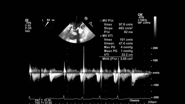 Afbeelding Van Het Hart Grijs Schaal Modus Tijdens Transesofageale Echografie — Stockfoto