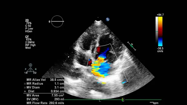 Image Cœur Lors Une Échographie Transœsophagienne Mode Doppler — Photo