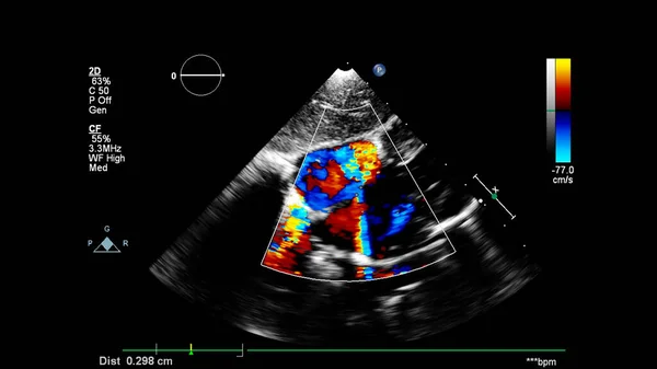 Immagine Del Cuore Durante Ecografia Transesofagea Con Modalità Doppler — Foto Stock