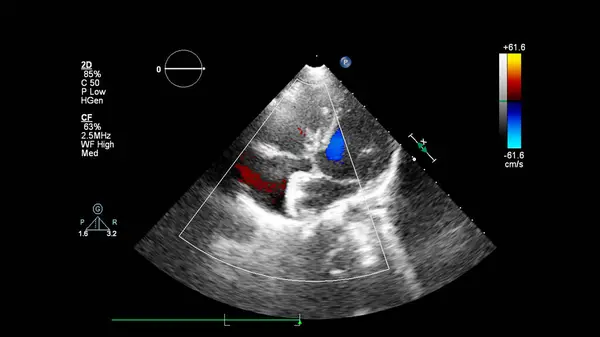 Image Cœur Lors Une Échographie Transœsophagienne Mode Doppler — Photo
