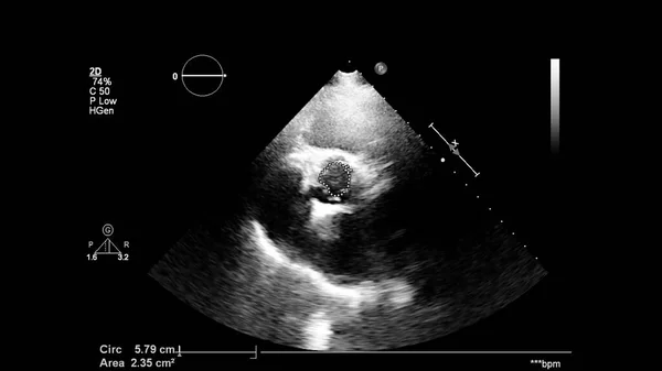 Transesofageal Ultrason Sırasında Kalbin Gri Ölçekli Görüntüsü — Stok fotoğraf