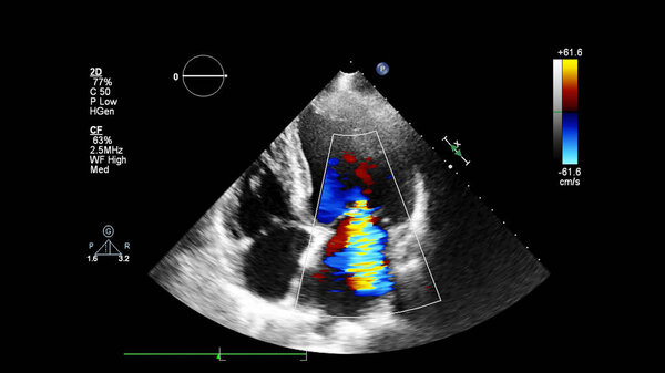 Изображение сердца во время трансофагеального ультразвука с доплеровским режимом.