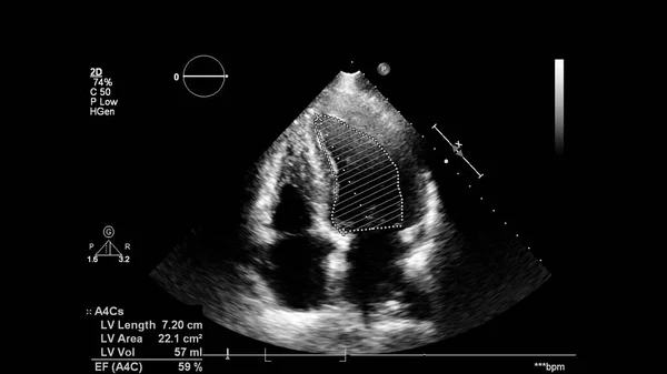 Kép Szív Szürke Skála Mód Során Transesophagealis Ultrahang — Stock Fotó