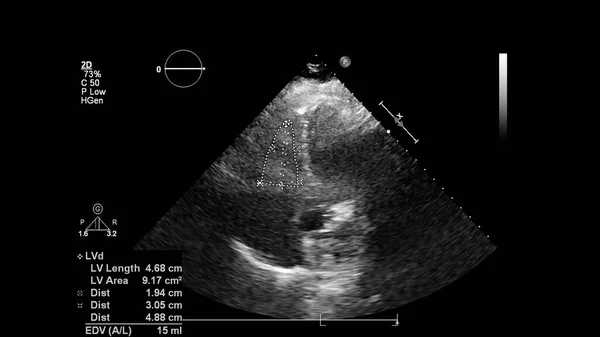 Image Heart Gray Scale Mode Transesophageal Ultrasound — Stock Photo, Image