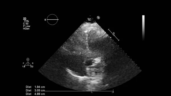 Abbildung Des Herzens Graustufen Modus Während Des Transesophagealen Ultraschalls — Stockfoto
