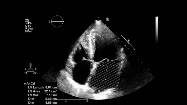 Image Heart Gray Scale Mode Transesophageal Ultrasound — Stock Photo, Image