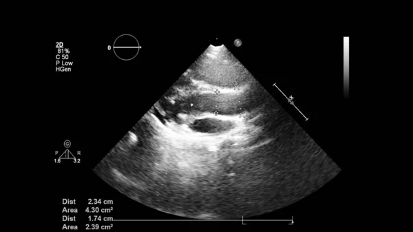 経食道超音波検査時のグレースケールモードで心臓の画像 — ストック写真