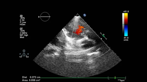Изображение Сердца Время Трансофагеального Ультразвука Доплеровским Режимом — стоковое фото