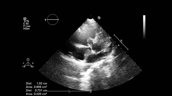 Image Heart Gray Scale Mode Transesophageal Ultrasound — Stock Photo, Image