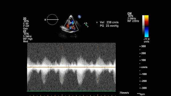 ドップラーモードで経食道超音波中の心臓の画像 ロイヤリティフリーのストック画像