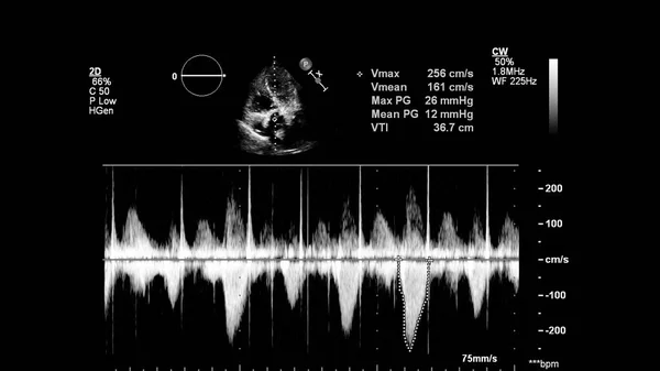 経食道超音波検査時のグレースケールモードで心臓の画像 ストック写真