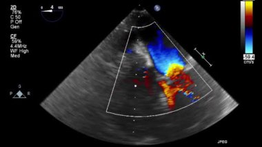 Kalbin ultrason transsofageal muayenesi.