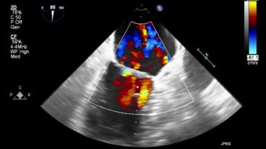 Kalbin ultrason transsofageal muayenesi.