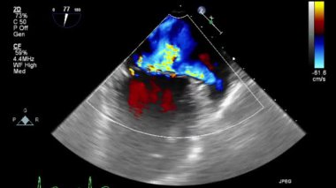 Kalbin ultrason transsofageal muayenesi.