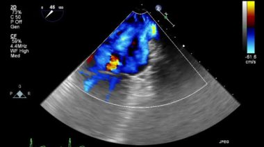 Kalbin ultrason transsofageal muayenesi.