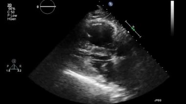 Kalbin ultrason transsofageal muayenesi.