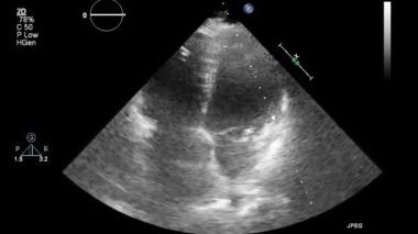 Kalbin ultrason transsofageal muayenesi.