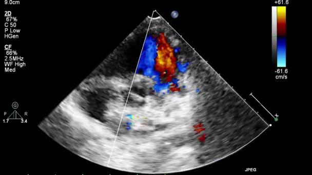 Ecografia Esame Transesofageo Del Cuore — Video Stock