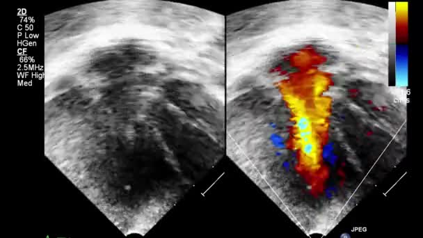 Ультразвуковое Трансофагеальное Исследование Сердца — стоковое видео