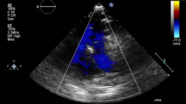 Ecografia Esame Transesofageo Del Cuore — Video Stock