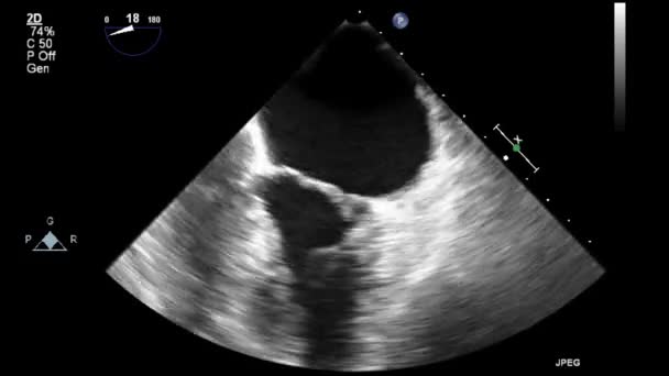 Ультразвуковое Трансофагеальное Исследование Сердца — стоковое видео