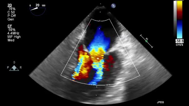 ลตราซาวด การตรวจสอบ Transesophageal ของห วใจ — วีดีโอสต็อก
