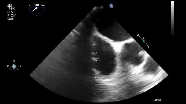 Ultrasound Transesophageal Examination Heart — Stock Video