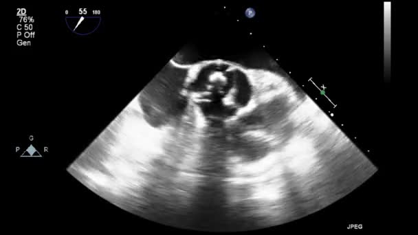 Ultrasound Transesophageal Examination Heart — Stock Video