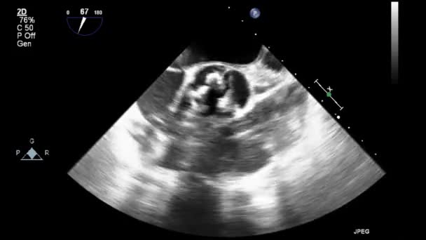 Ultraschall Transesophageale Untersuchung Des Herzens — Stockvideo