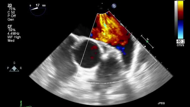 Ultrasound Transesophageal Examination Heart — Stock Video