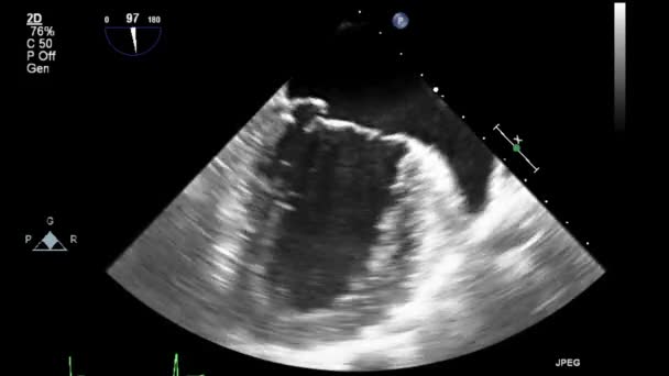 Echografie Transslokdarmonderzoek Van Het Hart — Stockvideo