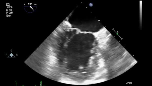 Ultraljudstransesofageal Undersökning Hjärtat — Stockvideo