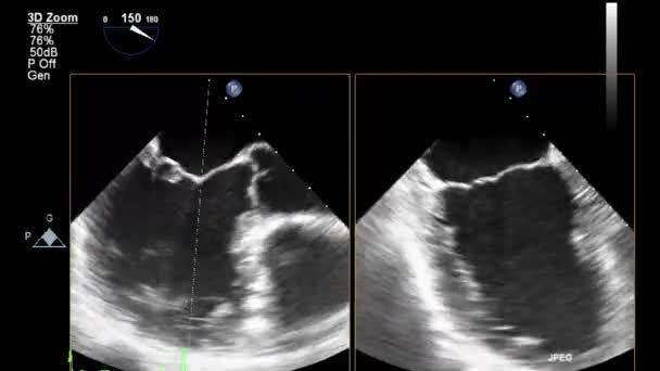 ลตราซาวด การตรวจสอบ Transesophageal ของห วใจ — วีดีโอสต็อก