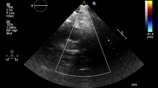 ลตราซาวด การตรวจสอบ Transesophageal ของห วใจ — วีดีโอสต็อก