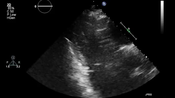 Ultrasound Transesophageal Examination Heart — Stock Video