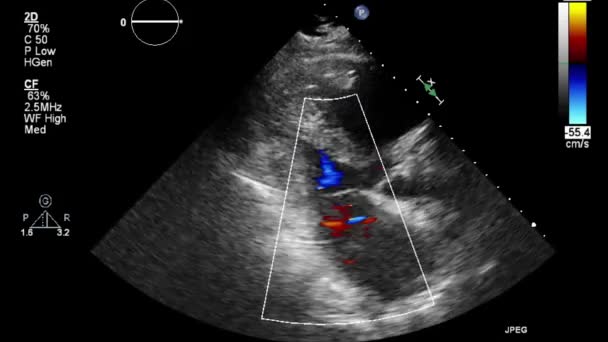 ลตราซาวด การตรวจสอบ Transesophageal ของห วใจ — วีดีโอสต็อก