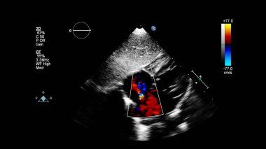 Transesofageal ultrason sırasında Doppler kipi ile kalbin görüntüsü.