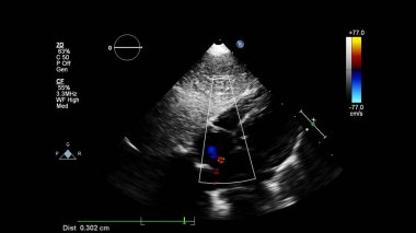 Transesofageal ultrason sırasında Doppler kipi ile kalbin görüntüsü.