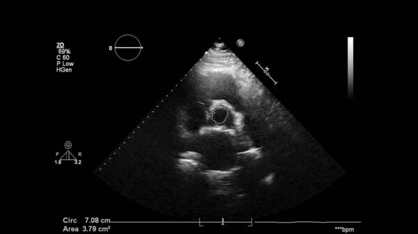 Изображение сердца в сером режиме во время трансофагеального ультразвука.