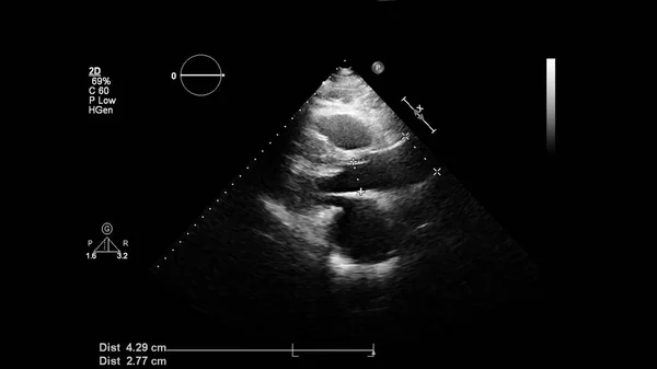 Image Cœur Mode Gris Lors Une Échographie Transœsophagienne — Photo